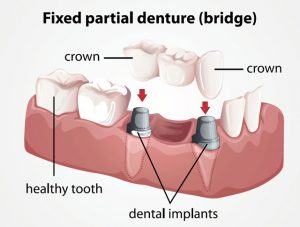 dental bridge